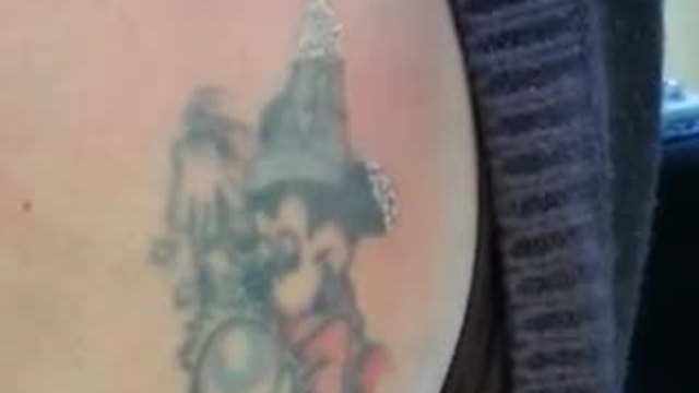 Момиче премахва татуировка от гърдите си с лазер